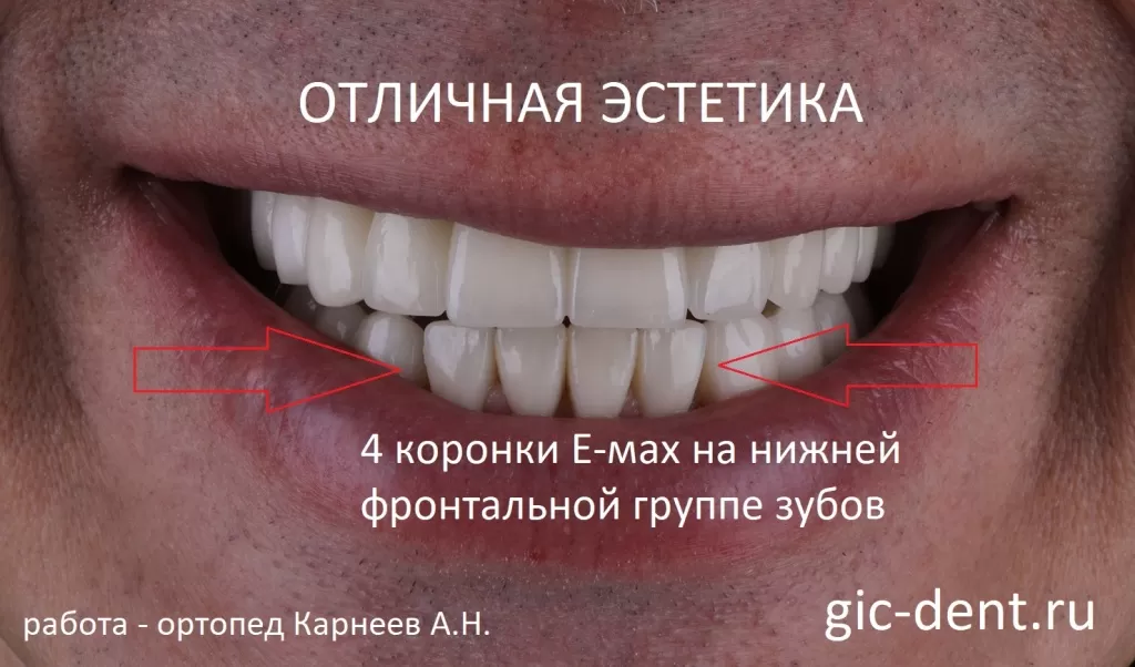 Керамические коронки E-Max могут использоваться для замещения одного или нескольких отсутствующих зубов